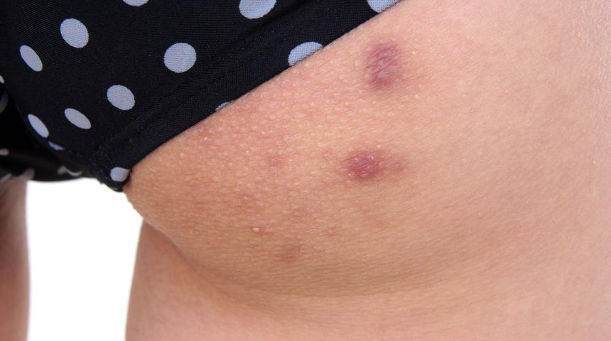 Şehir efsanesi değil artık sivilcelerden karbonatla kurtulacaksınız