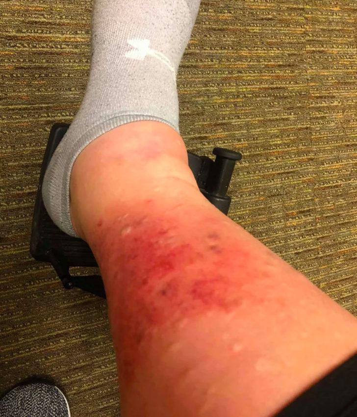 Jakuziden mikrop kapınca neredeyse bacağını kaybediyordu!  G4