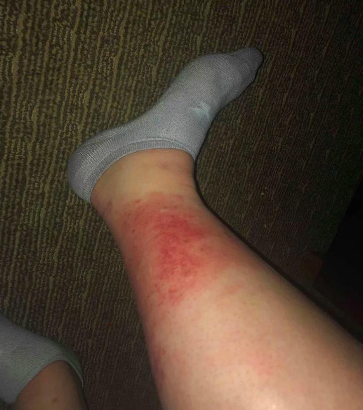 Jakuziden mikrop kapınca neredeyse bacağını kaybediyordu!  G3