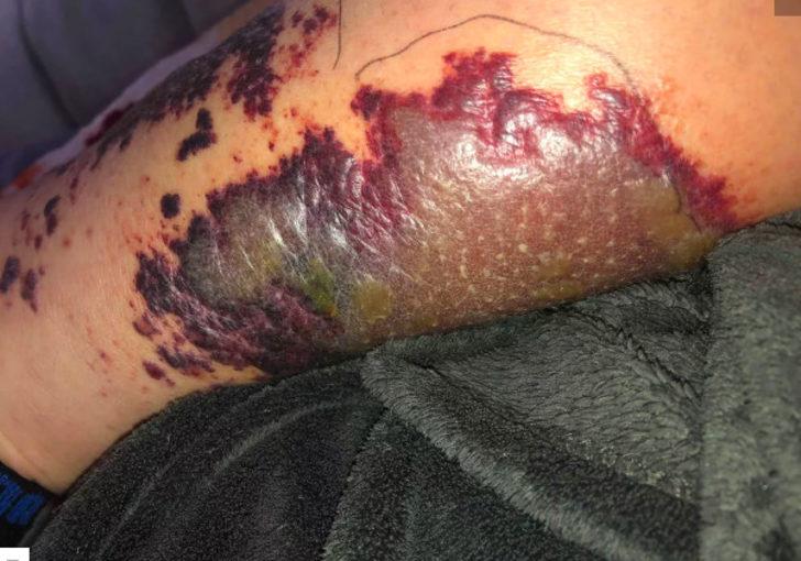 Jakuziden mikrop kapınca neredeyse bacağını kaybediyordu!  G5