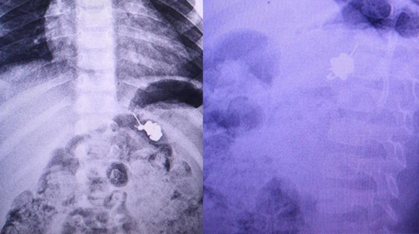 Şeker zannederek yuttu! Fark eder etmez hastaneye koştular