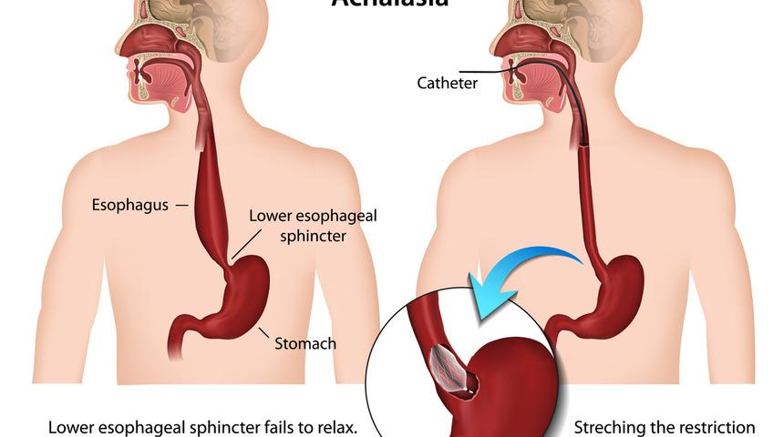 Diyafragma fıtığı nedir? Diyafragma fıtığı belirtileri nelerdir? Diyafragma fıtığı tedavisi nasıl olur?