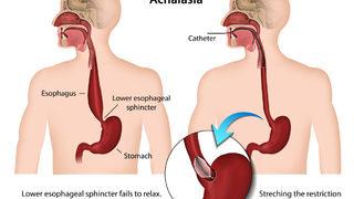 Diyafragma fıtığı nedir? Diyafragma fıtığı belirtileri nelerdir? Diyafragma fıtığı tedavisi nasıl olur?