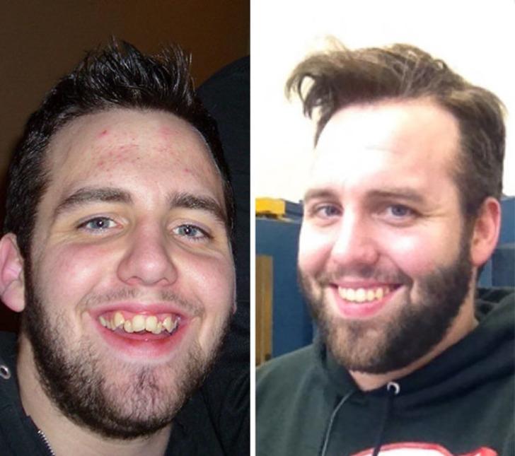 Ey diş teli sen nelere kadirsin! İnanılmaz değişim... G2