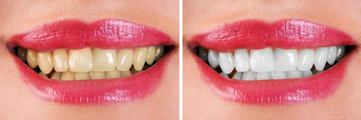 Dişlerinizi beyazlatayım derken çürütmeyin!  İşte yapılan o büyük yanlış... G3