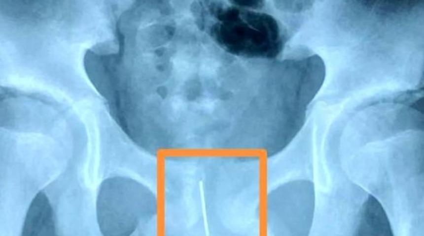 Uyumamak i&ccedil;in cinsel organına iğne koydu! Durumu annesi fark etti