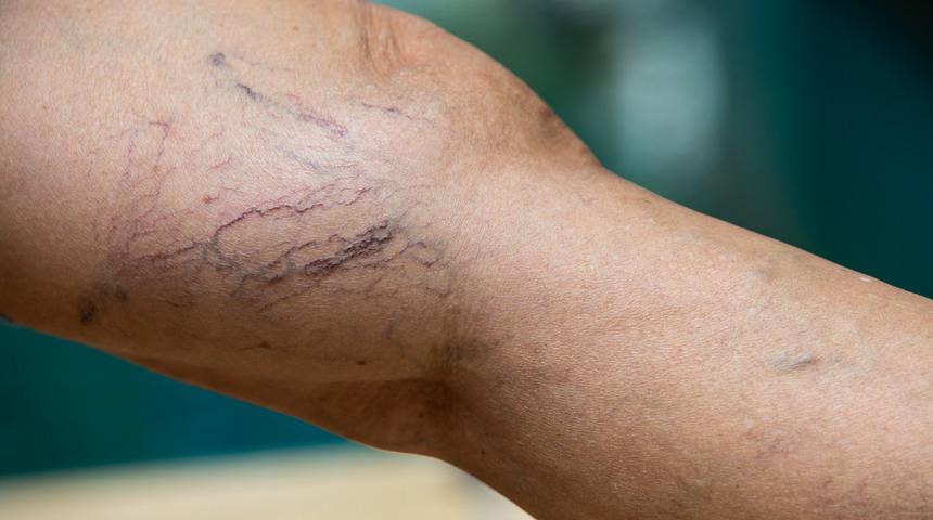 Damar bozukluğu (Vask&uuml;ler Malformasyon) yaşam kalitenizi bozabilir