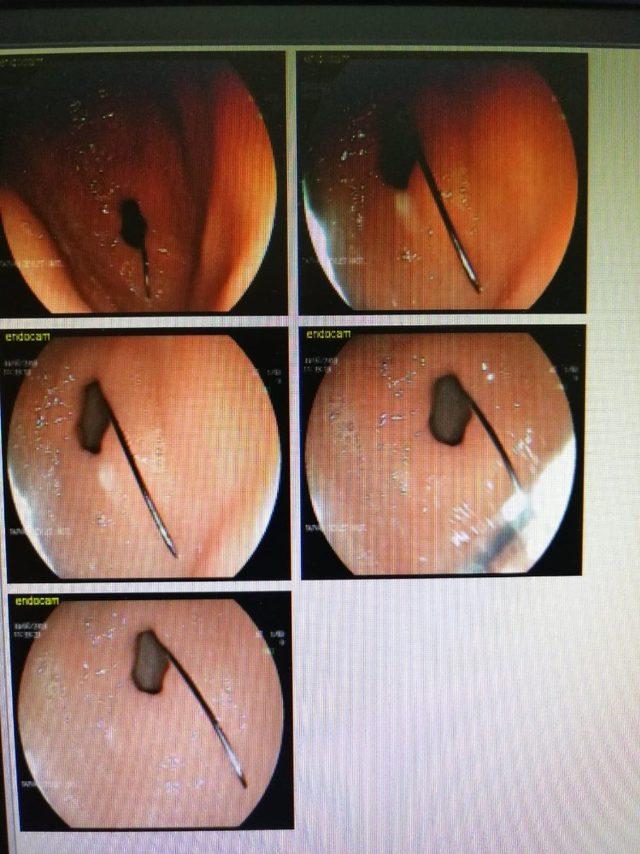 Yanlışlıkla yuttuğu iğne 3 ay sonra operasyonla çıkarıldı