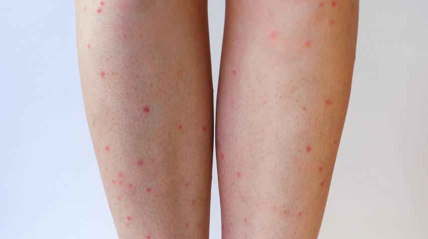 &Ccedil;ilek bacak nasıl ge&ccedil;er? 