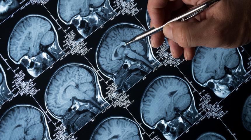 Epilepsi nedir? Epilepsi tedavisinde ilaçlar kilit rol oynuyor