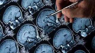Epilepsi nedir? Epilepsi tedavisinde ilaçlar kilit rol oynuyor