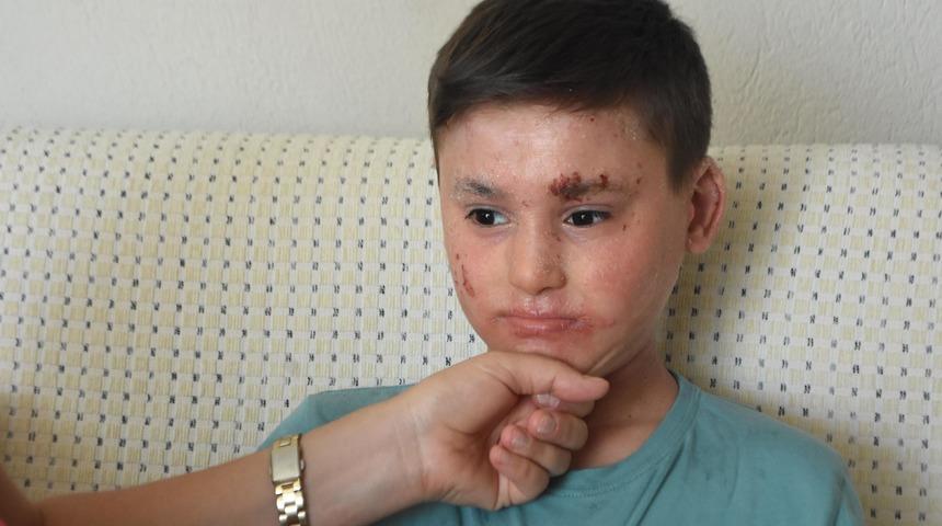 Balık derisi hastası Kayra'yı sevindiren haber