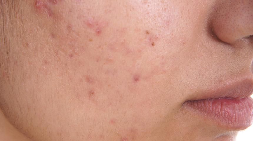 Dermatologlar uyarıyor: Güneş cildinizi yakmasın!