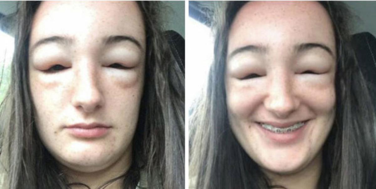 Y&uuml;z&uuml; bir anda şişmeye başladı ama o fotoğraf &ccedil;ekmeye devam etti!