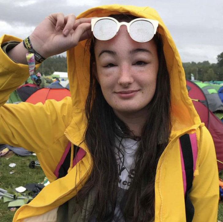 Yüzü bir anda şişmeye başladı ama o fotoğraf çekmeye devam etti! G1