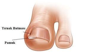 Tırnak batması derdine son! Bitmeyen çileden kurtaracak etkili yöntemler 