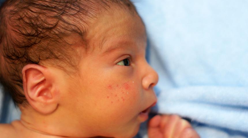 Yenidoğan bebeklerde en sık g&ouml;r&uuml;len cilt d&ouml;k&uuml;nt&uuml;leri