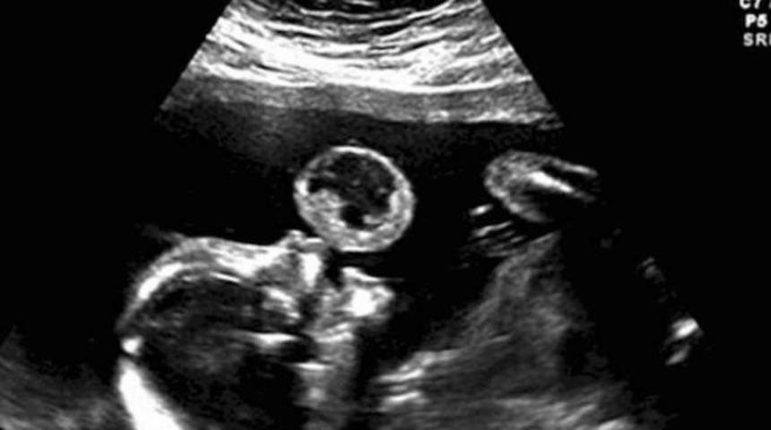 Anne Adayları Kontrollerinizi Aksatmayın: Ultrasonda G&ouml;r&uuml;nen Baloncuk Sanıldığından Daha Tehlikeli &Ccedil;ıktı