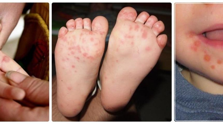 Su &Ccedil;i&ccedil;eği, Kızamık Derken; &Ccedil;ocuklarınızı Bekleyen Yeni Tehlike: HFMD!