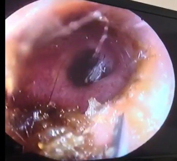 Antalya'da şaşkınlık veren olay! Kulağından canlı kelebek çıktı G2