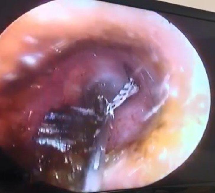 Antalya'da şaşkınlık veren olay! Kulağından canlı kelebek çıktı G3