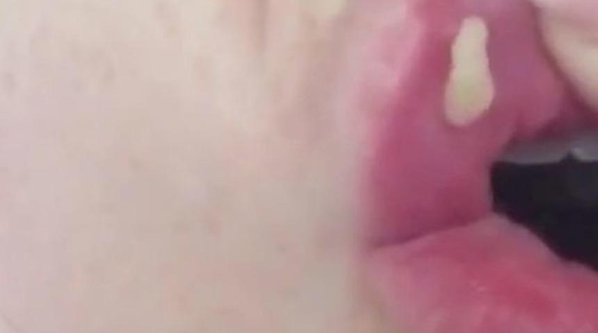 Ucuz ürünlerin kullanıldığı  dudak dolgu malzemeleri bakın neye yol açıyor! 