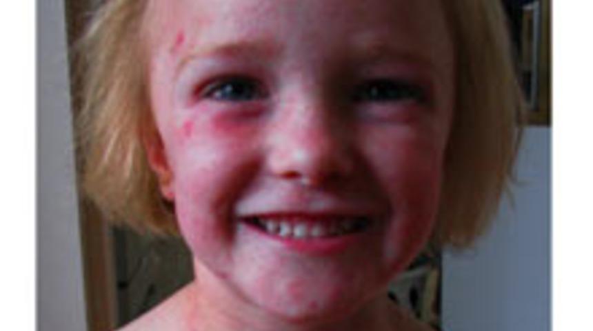 Kızamıktan Korunmanın Yolları