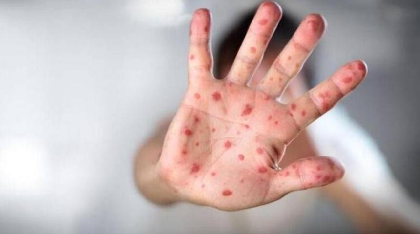 &Ccedil;ocuklarda el, ayak ve ağız hastalığı hastalığına dikkat
