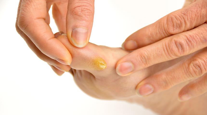 Y&uuml;ksek topuklu ayakkabılar nasır sebebi