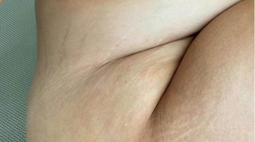 Ashley Graham yine şaşırtmadı! Bu kez çatlak izlerini paylaştı