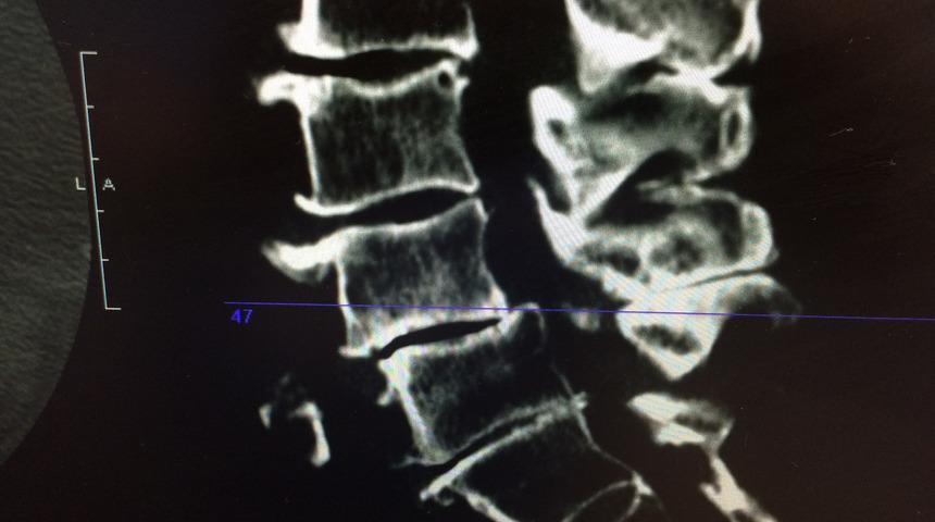Dar kanal hastalığı nedir? Dar kanal hastalığı tedavisi 
