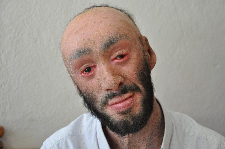 Cilt hastası Töre iyileşmek istiyor G1