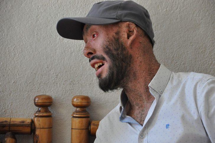 Cilt hastası Töre iyileşmek istiyor G2