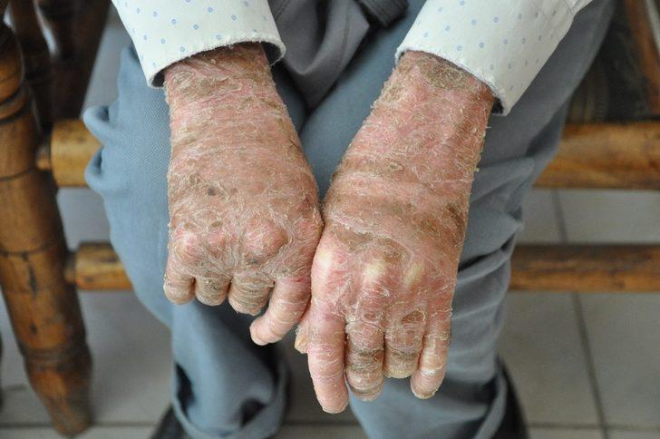 Cilt hastası Töre iyileşmek istiyor G4