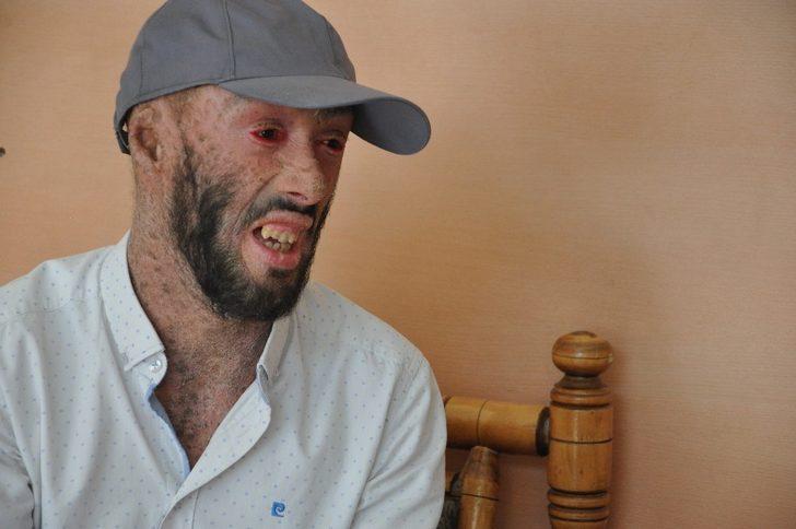 Cilt hastası Töre iyileşmek istiyor G5