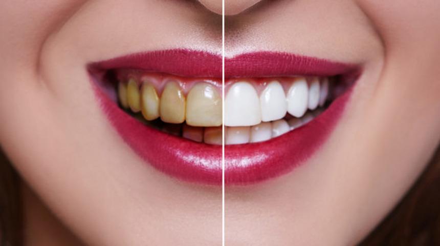 Dişlere zarar veren 7 yiyecek ve içecek