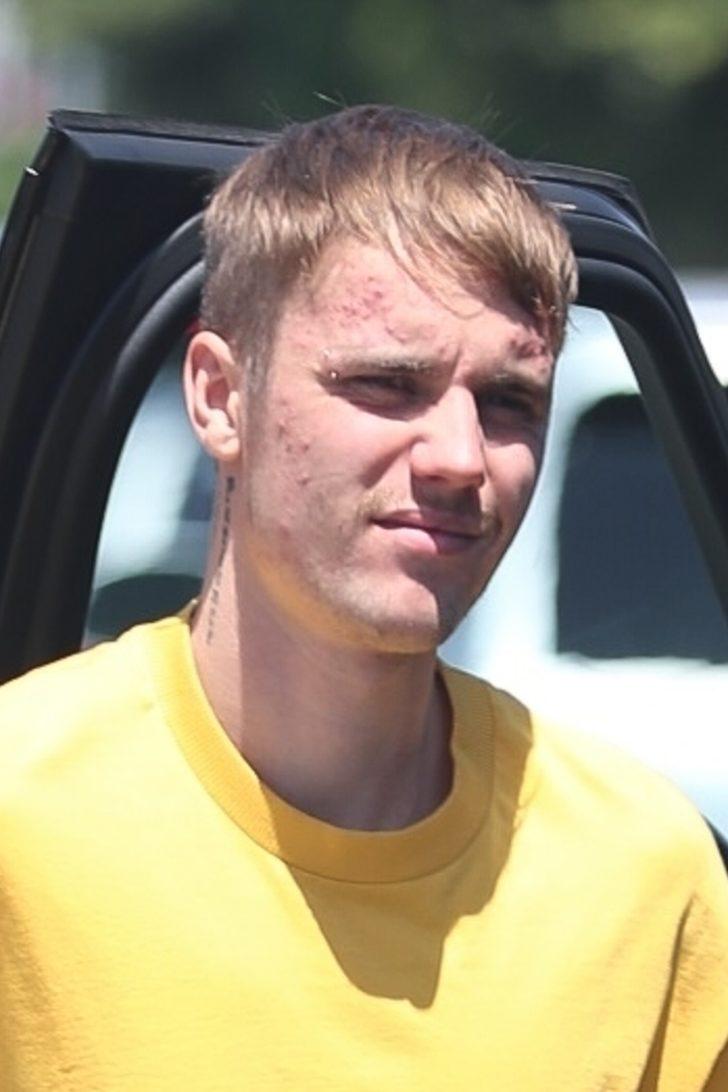 Justin Bieber'ın yüzünü sivilce bastı G3