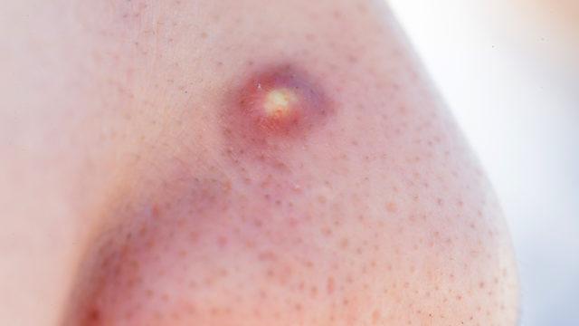 Hepimiz yapıyoruz artık iki kere düşüneceksiniz! 'Ölüm üçgeni', felce hatta ölüme bile yol açabiliyor