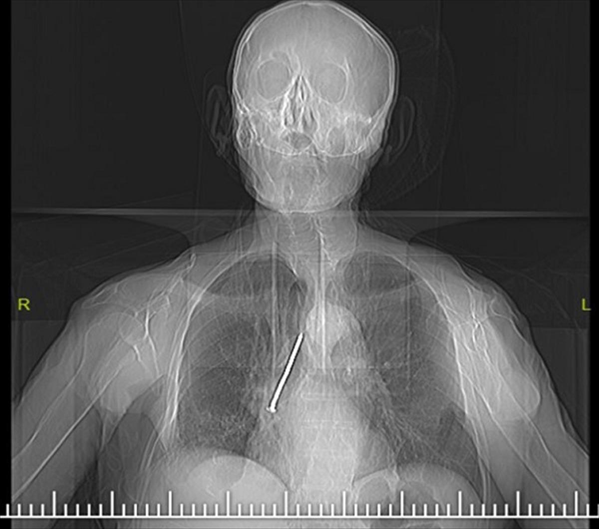 Nefes darlığı şikayetiyle gitti, hayatının şokunu yaşadı!