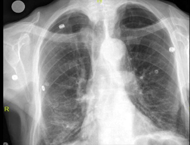 Nefes darlığı şikayetiyle gitti, hayatının şokunu yaşadı! G4