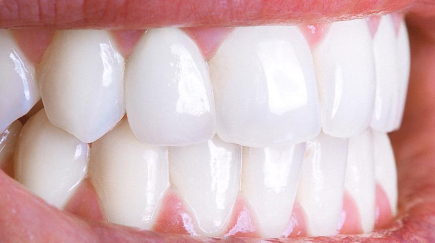 Hollywood gülüşünde diş rengine dikkat 