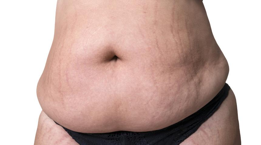 Vücut çatlakları kadınların psikolojisini bozuyor 