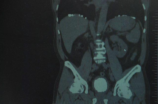 Mesanesinde 220 gramlık tek parça taş çıktı