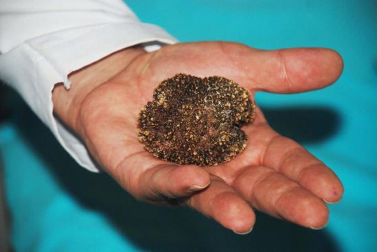 Ameliyatı yapan doktor şaştı kaldı: 30 yıllık meslek hayatımda g&ouml;rd&uuml;ğ&uuml;m en b&uuml;y&uuml;k mesane taşı