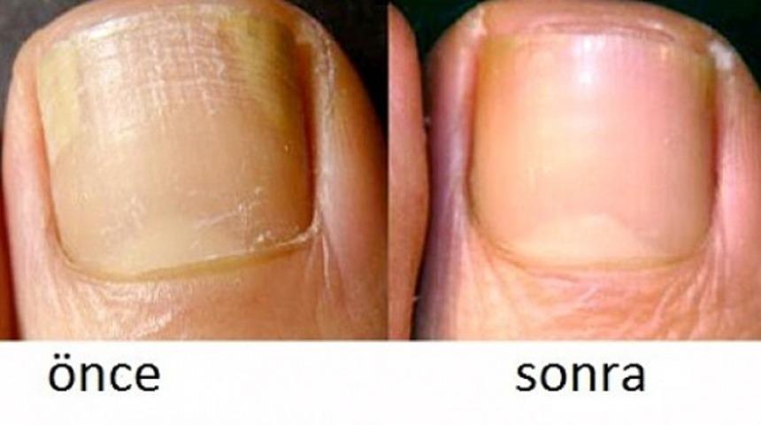 Ayak Mantarını Evde Tedavi Etmenin 6 Kolay Yolu