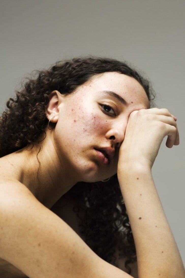 Makyaj yok, filtre yok! Kadınlar 'kusurlu' cildin damgalanmasına meydan okuyor  G1