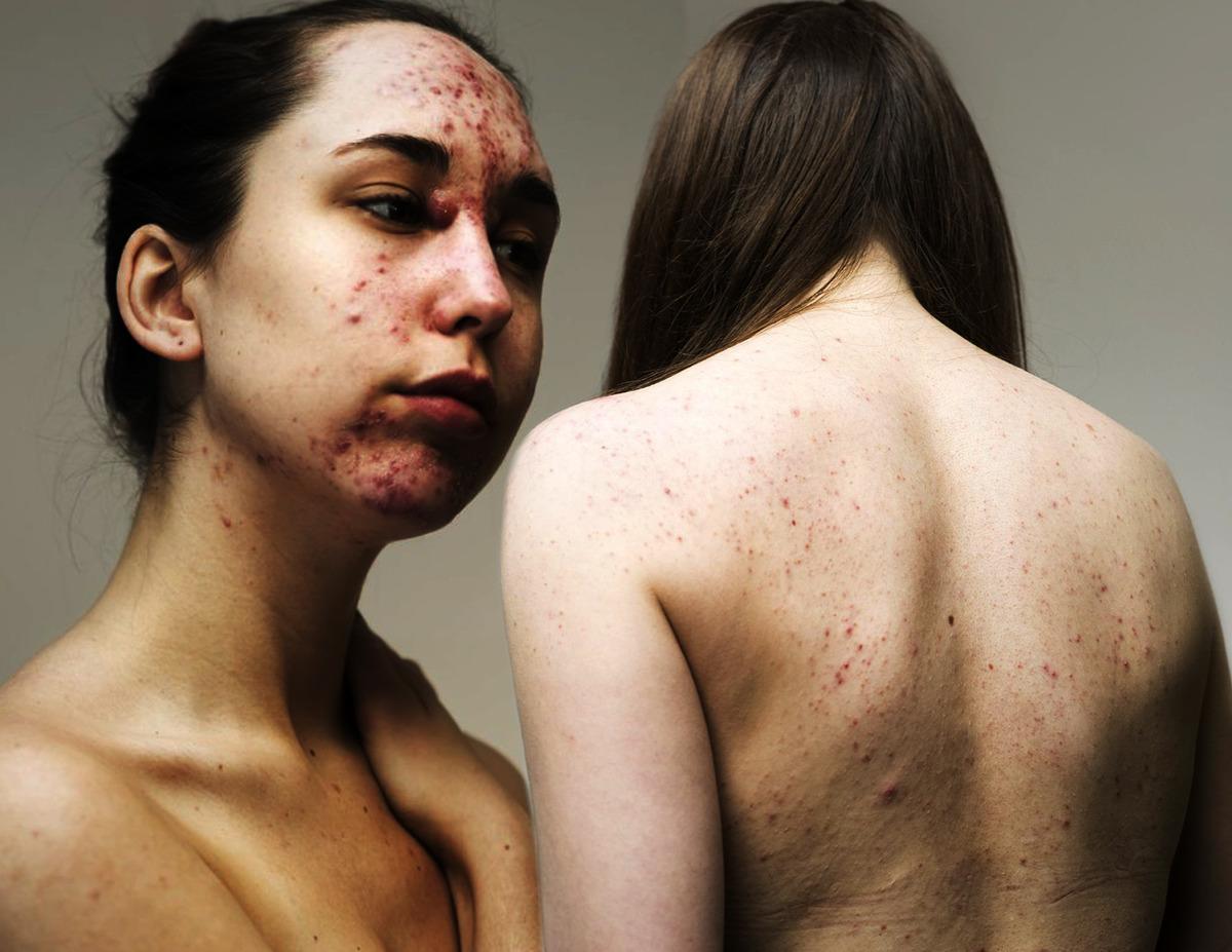 Makyaj yok, filtre yok! Kadınlar 'kusurlu' cildin damgalanmasına meydan okuyor 