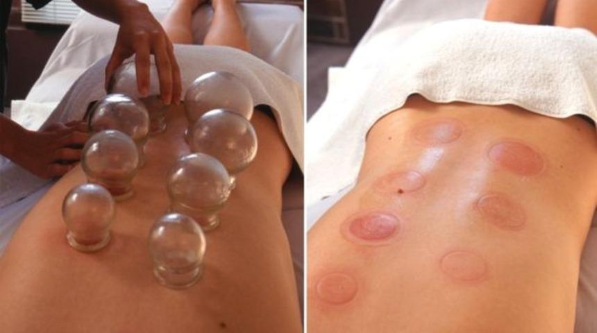 Bardak çekme tedavisinin 4 inanılmaz faydası