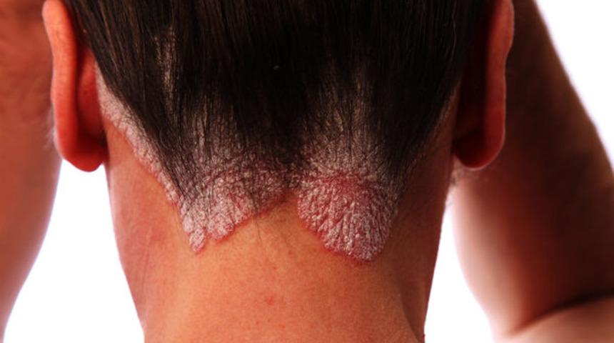 Egzama bitkisel tedaviyle tarihe karıştı 