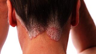 Egzama bitkisel tedaviyle tarihe karıştı 